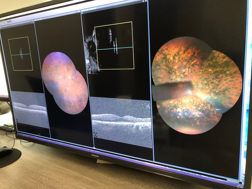 AI-powered retinal scan used to detect diabetic retinopathy