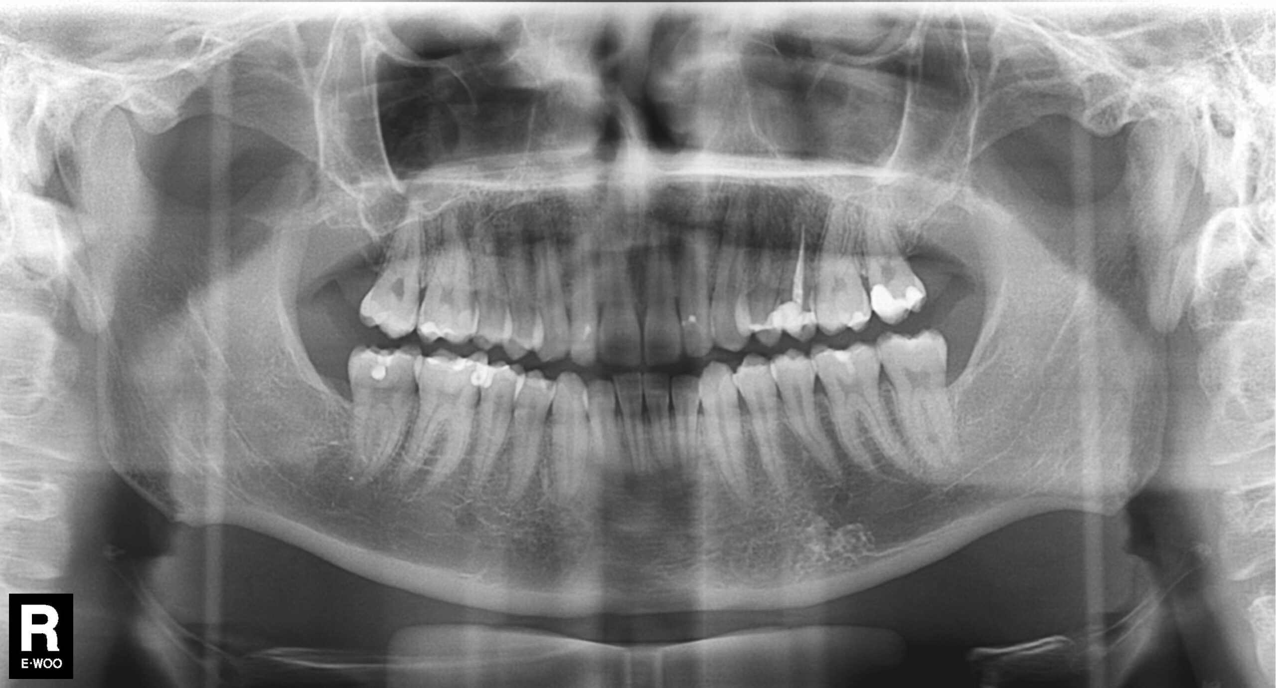 Panoramic dental X-ray of a full set of teeth, the kind of radiograph AI dental software analyses for cavities and bone loss
